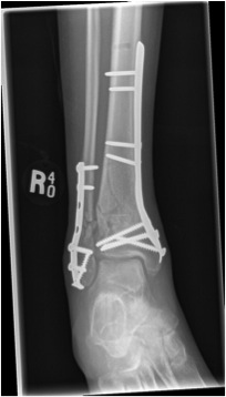 distal tibial fracture orif tibia plate
